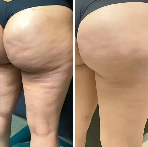 Fotka před a po nošení legín Legipress — Jana, 37 — po 4 týdnech denního nošení