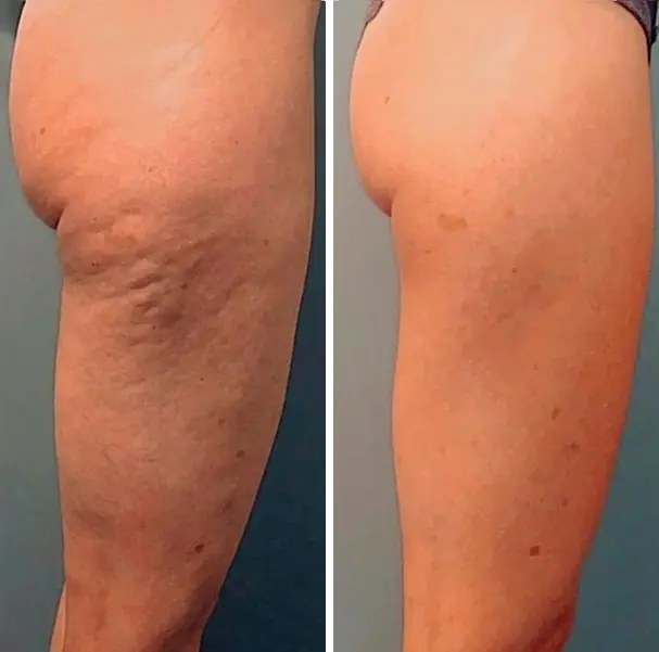 Fotka před a po nošení legín Legipress — Martina, 43 — po 3 týdnech nošení