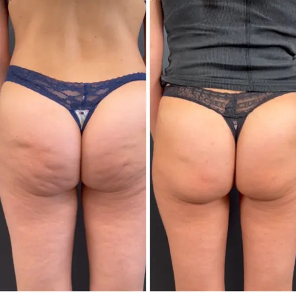 Fotka před a po nošení legín Legipress — Anna, 41 — po 6 týdnech nošení