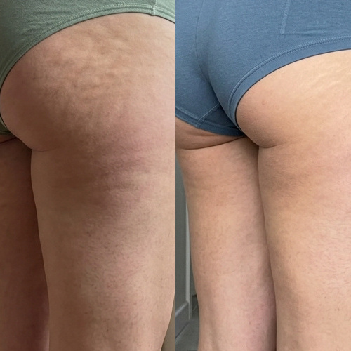 Fotka před a po nošení legín Legipress — Petra, 39 — po 4 týdnech nošení